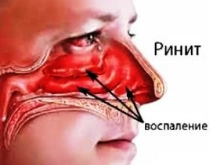 Рак полости носа и придаточных пазух: симптомы, признаки, лечение, прогноз