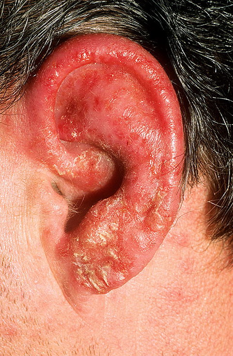 Рожистое воспаление уха код мкб