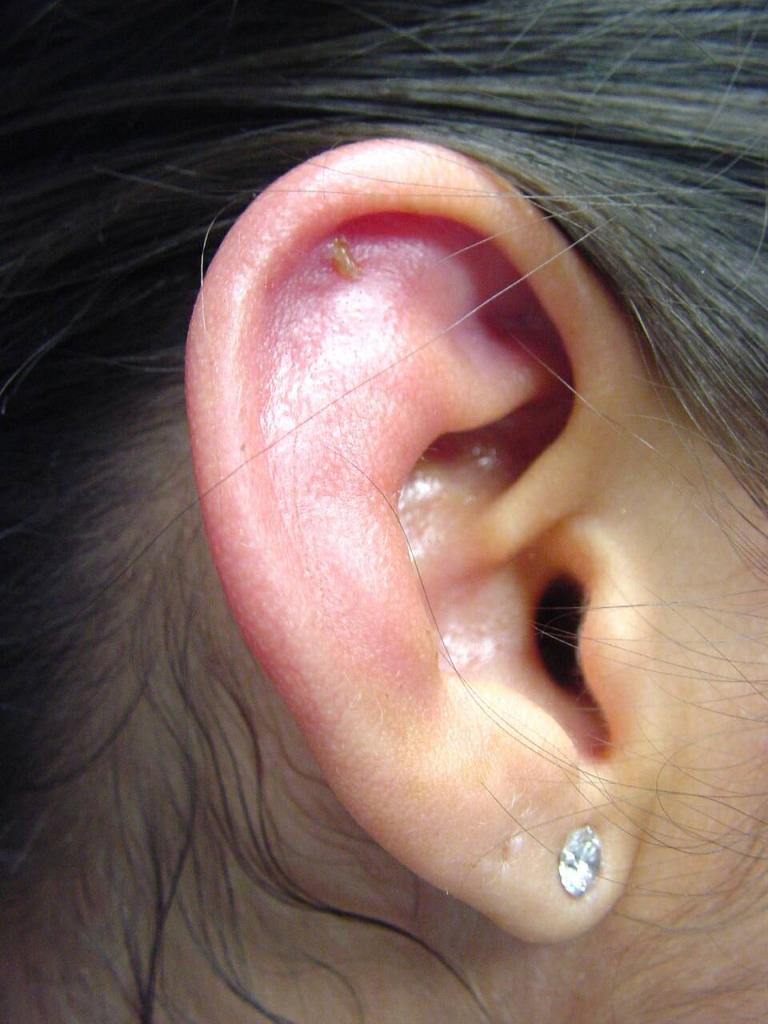 Боль в ушах - что делать, причины и лечение