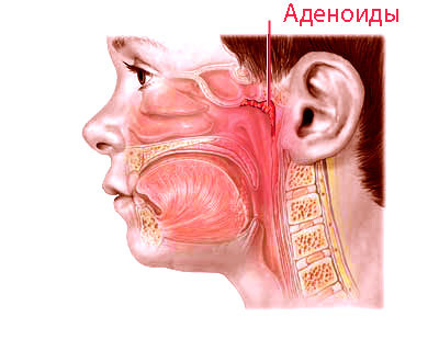 Лечение хронической заложенности носа: полипоза, ринита, синусита и других нарушений дыхания