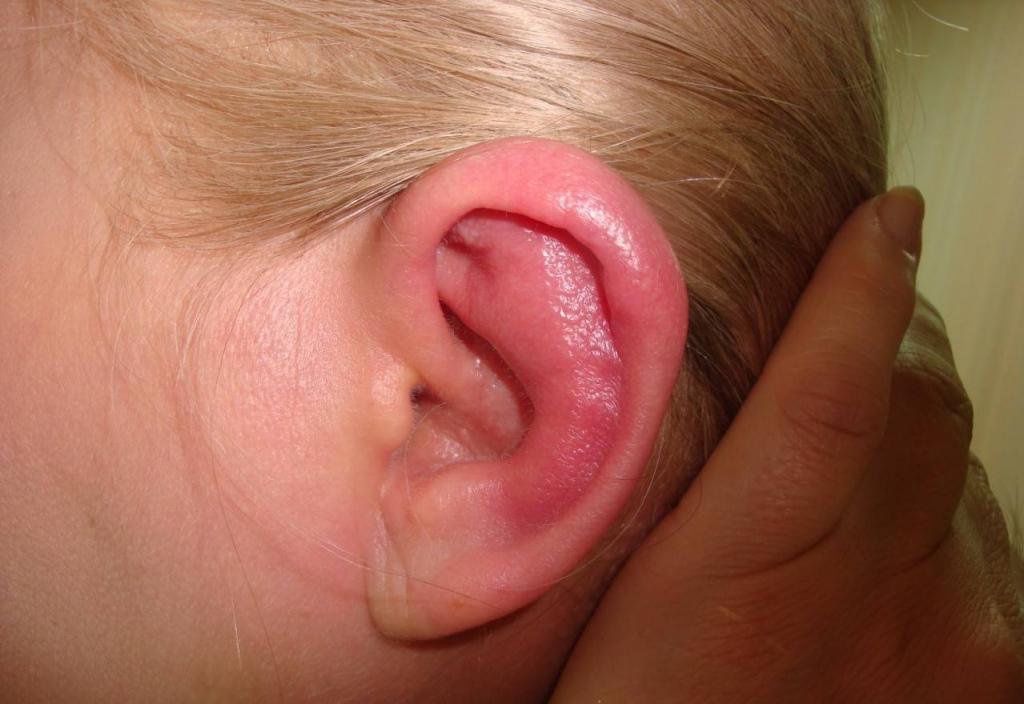 Воспаление ушной раковины, перихондрит наружного и внешнего уха