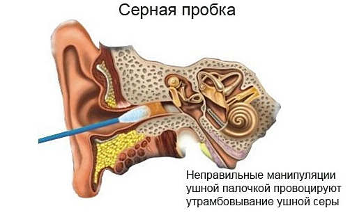 Симптомы серной пробки в ухе у взрослого