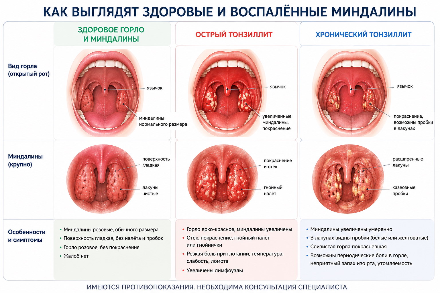 Здоровые и воспаленные миндалины2.jpg Здоровые и воспаленные миндалины2.jpg