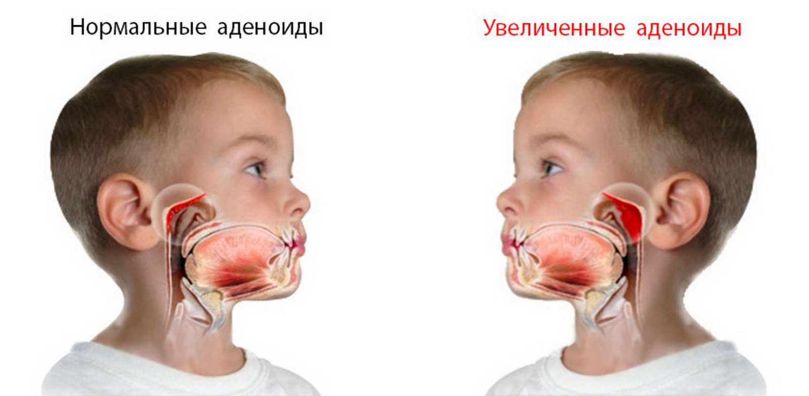 Ингаляции интерфероном при аденоидах - Педиатрия - - Здоровье hb-crm.ru