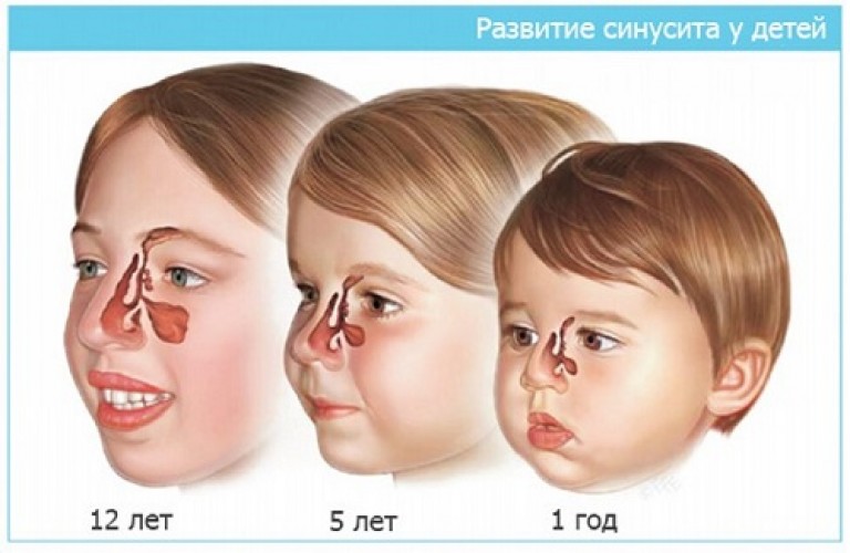 Как лечить кашель при синусите у ребенка
