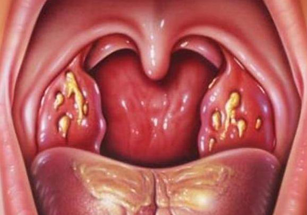 Визуальный осмотр горла