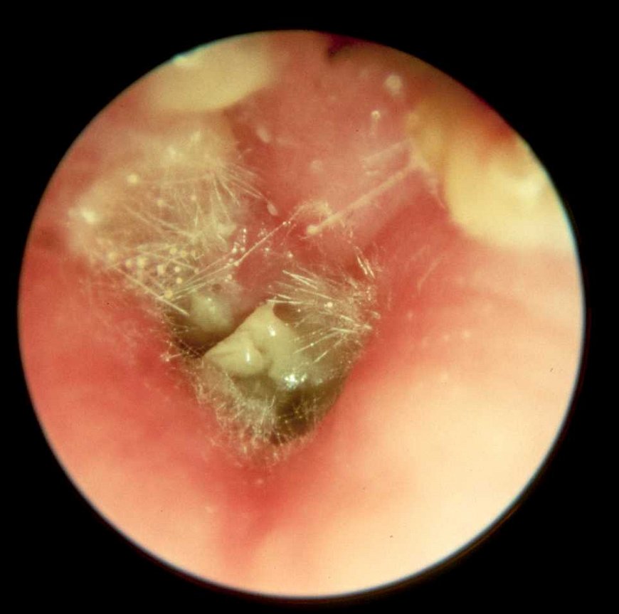 Лечение грибкового отита наружного уха