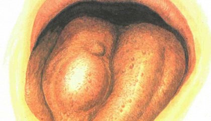 Сифилис в горле — стадии, симптомы, диагностика и лечение